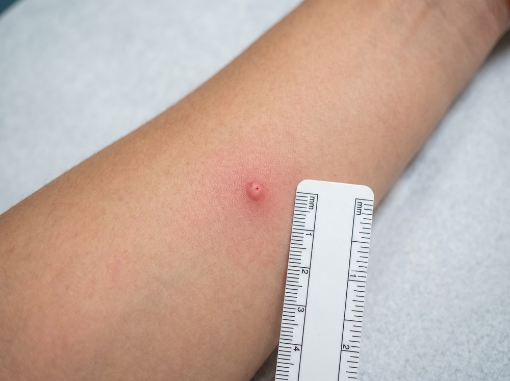 Close-up of a mild spider bite mark on human skin showing faint pink redness with no blistering, swelling, or visible pattern