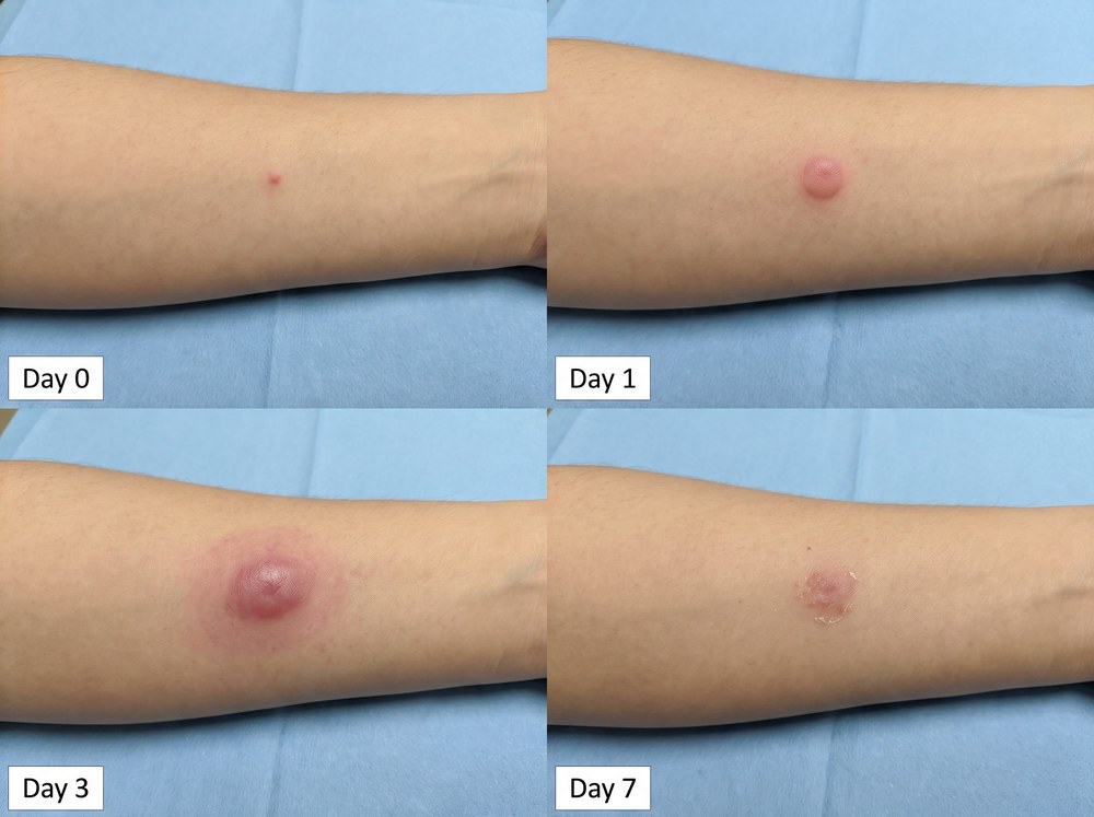 Four panel progression photo of a mild bite mark healing from faint redness on day zero to normal skin by day seven